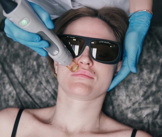 Candela GentleMax Pro Plus